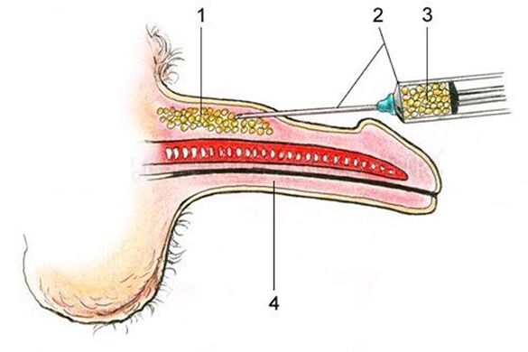 Lipofilling - a introdução de tecido adiposo no eixo do pênis