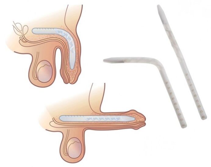 Falloplastia para aumentar um membro