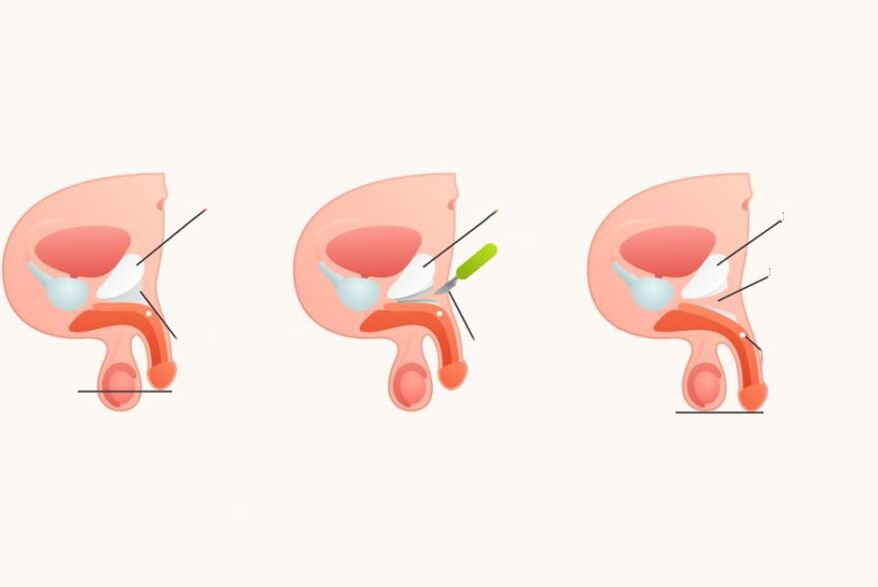Ligamentotomia para aumentar o pênis