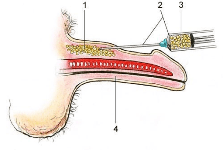 lipofilia para aumentar um membro