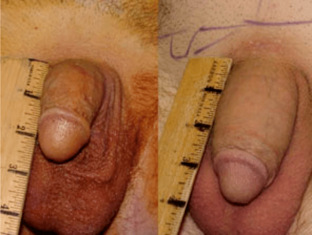 Antes e depois do lipofilling e implantação do gel