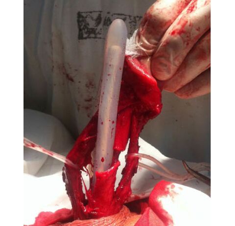Transplante de tecido muscular para aumentar o pênis