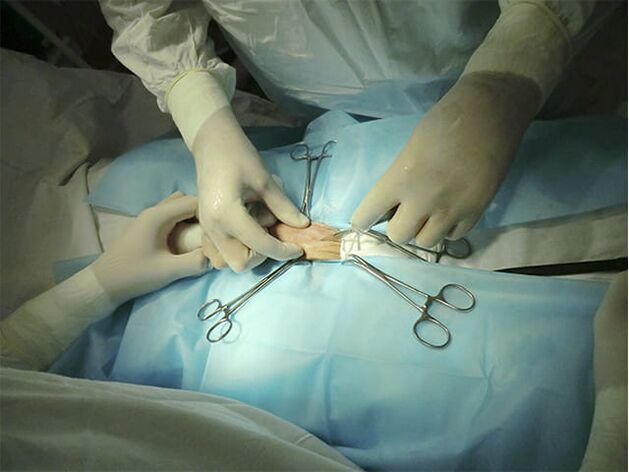 cirurgia para aumentar o pênis
