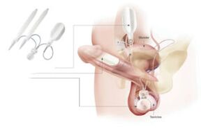 inserção de implantes no pênis